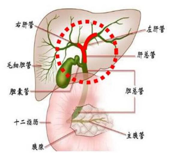 首先行十二指肠镜下经十二指肠胆道造影术(ercp 鼻胆管引流术(enbd)