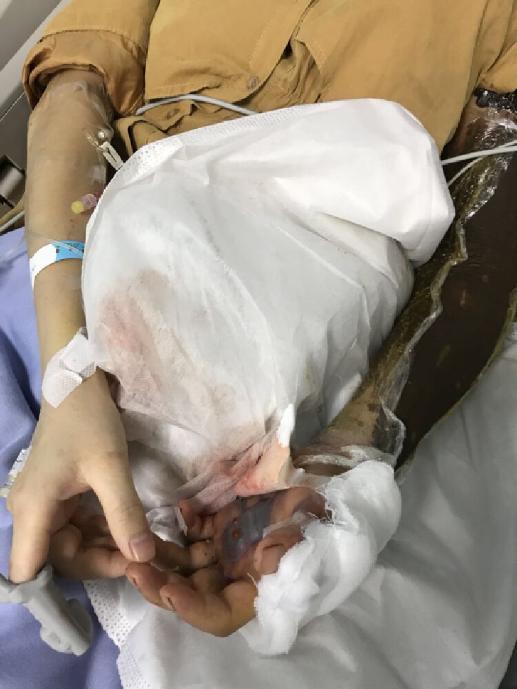 秋冬季仍要小心蛇出没 深圳中医院每年蛇伤病患超千例