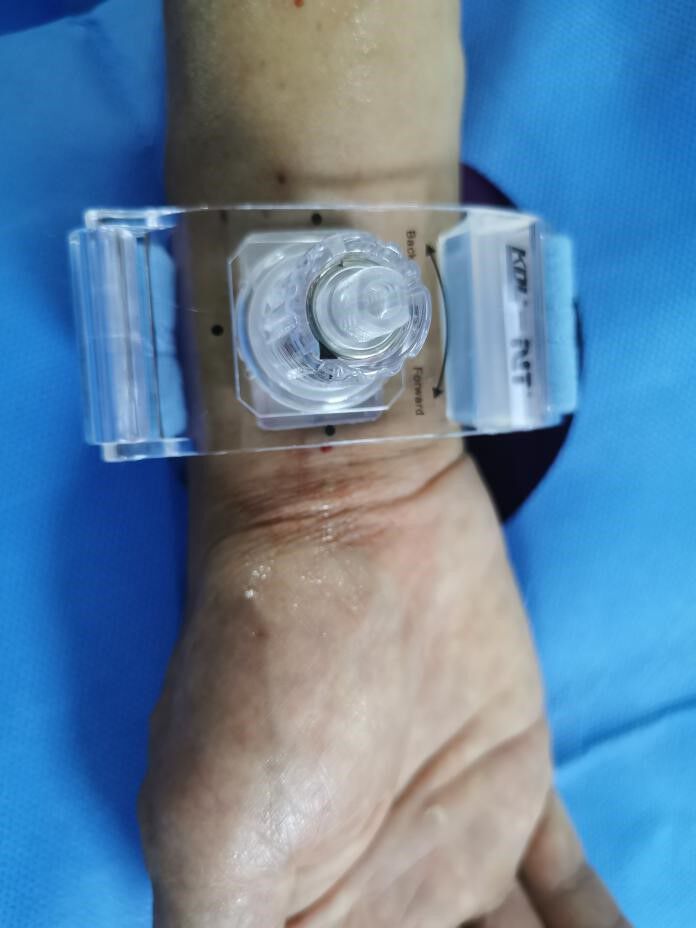 术后使用压迫器压迫固定桡动脉