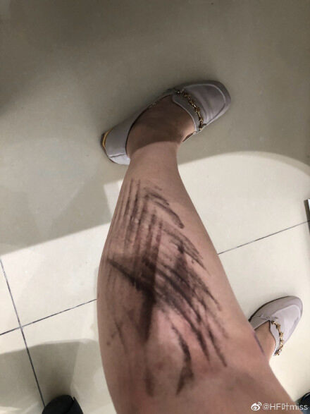 女子腿部卡入地铁站台 保安发现拼命拽出