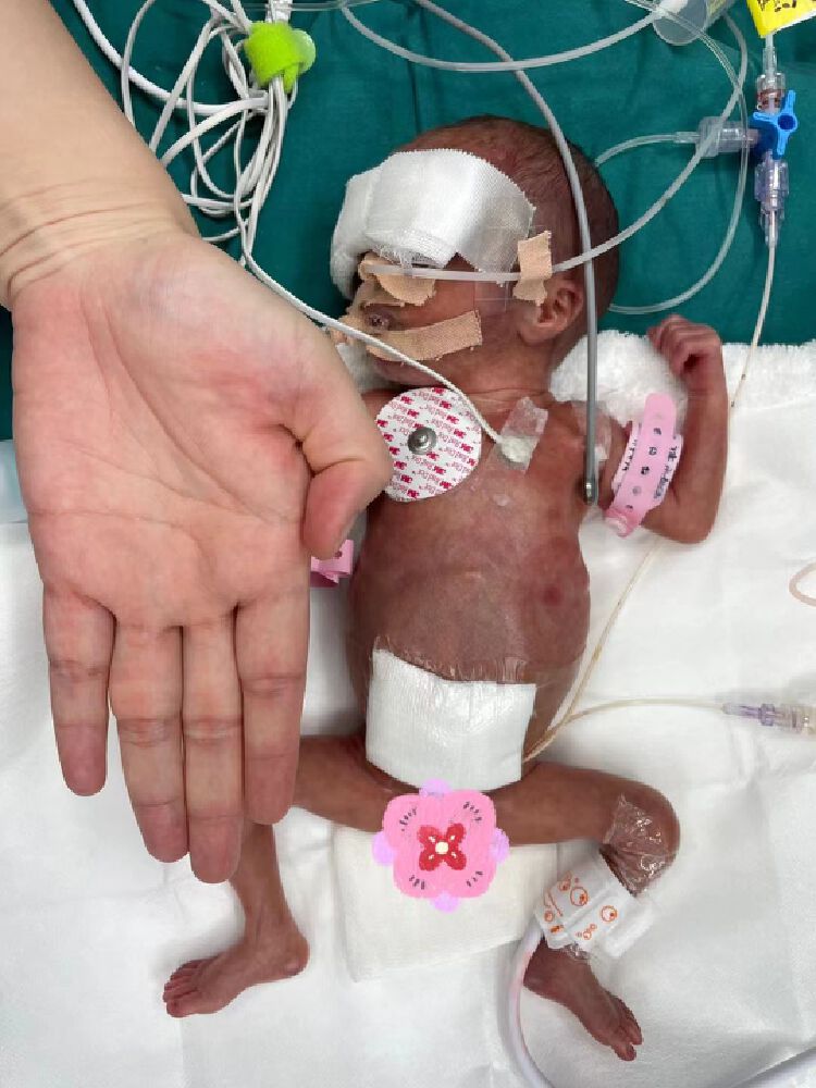 近日,一位怀孕27周的孕妇,因完全性前置胎盘大出血(出血量达3000ml)