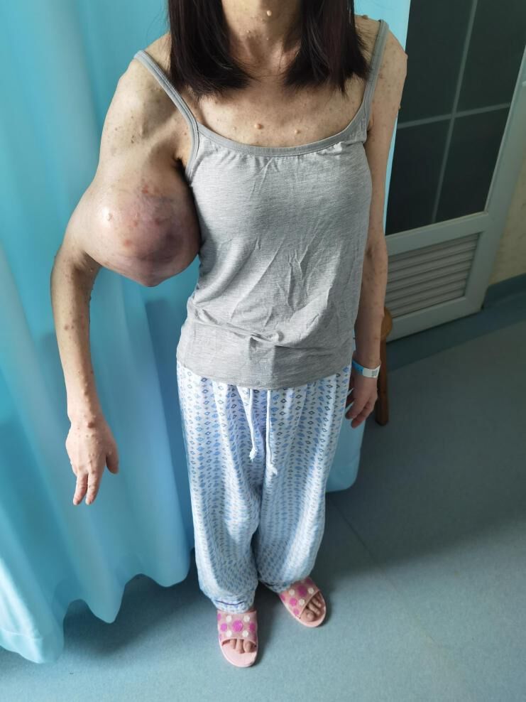 肿瘤不痛就不在意小心恶化猛长